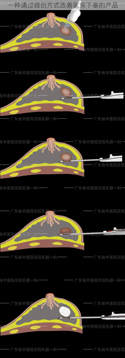 一种通过微创方式改善乳房下垂的产品