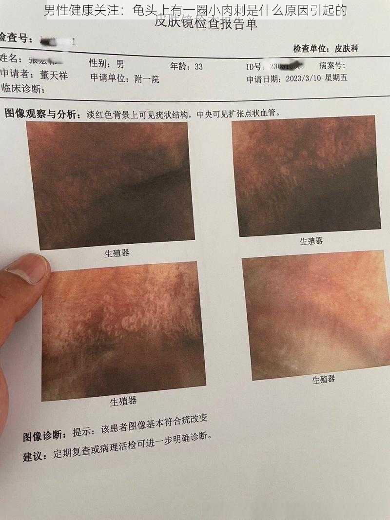 男性健康关注:龟头上有一圈小肉刺是什么原因引起的