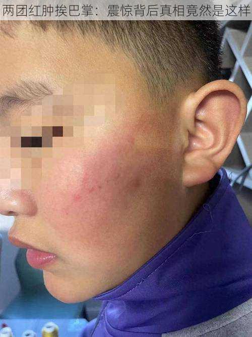 两团红肿挨巴掌:震惊背后真相竟然是这样