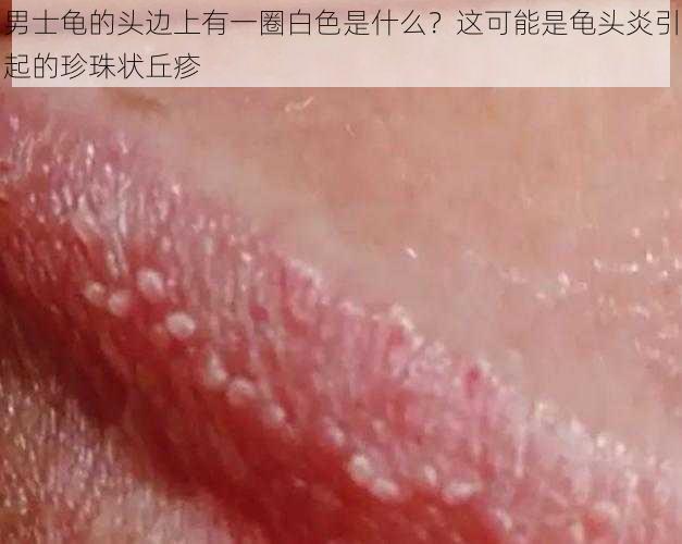 男士龟的头边上有一圈白色是什么?这可能是龟头炎引起的珍珠状丘疹